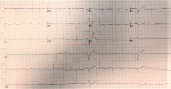 EKG printout from patient experiencing bradycardia.