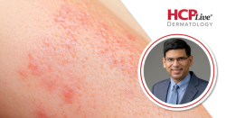 Lebrikizumab Effectively Treats AD in Patients with Skin of Color, With Vinay Mehta, MD