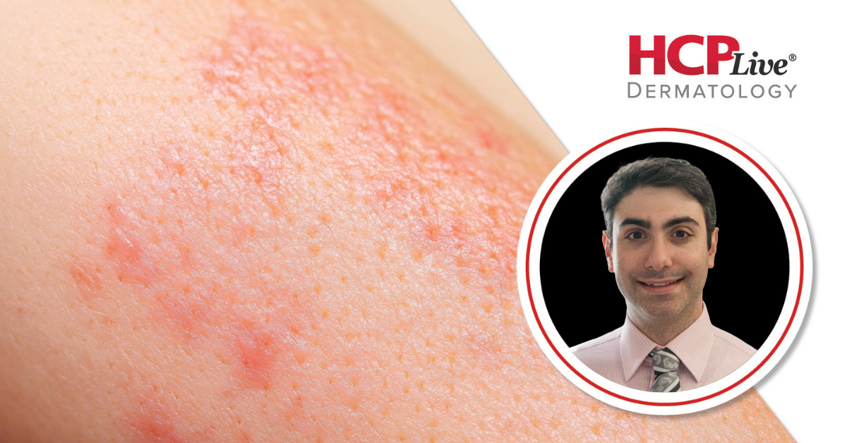 STAT6, ITK Inhibitors, IL-31, & IL-18 Headline Burgeoning Pipeline in Atopic Dermatitis, with David Rosmarin, MD