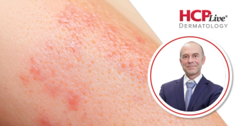 Understanding Temtokibart's Potential in Atopic Dermatitis, With Stephan Weidinger, MD, PhD