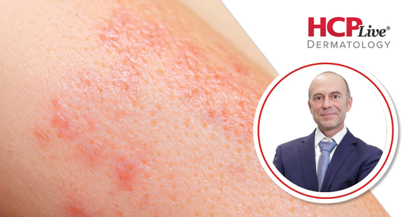 5-Year ADlong Data on Lebrikizumab for Eczema, With Stephan Weidinger, MD, PhD