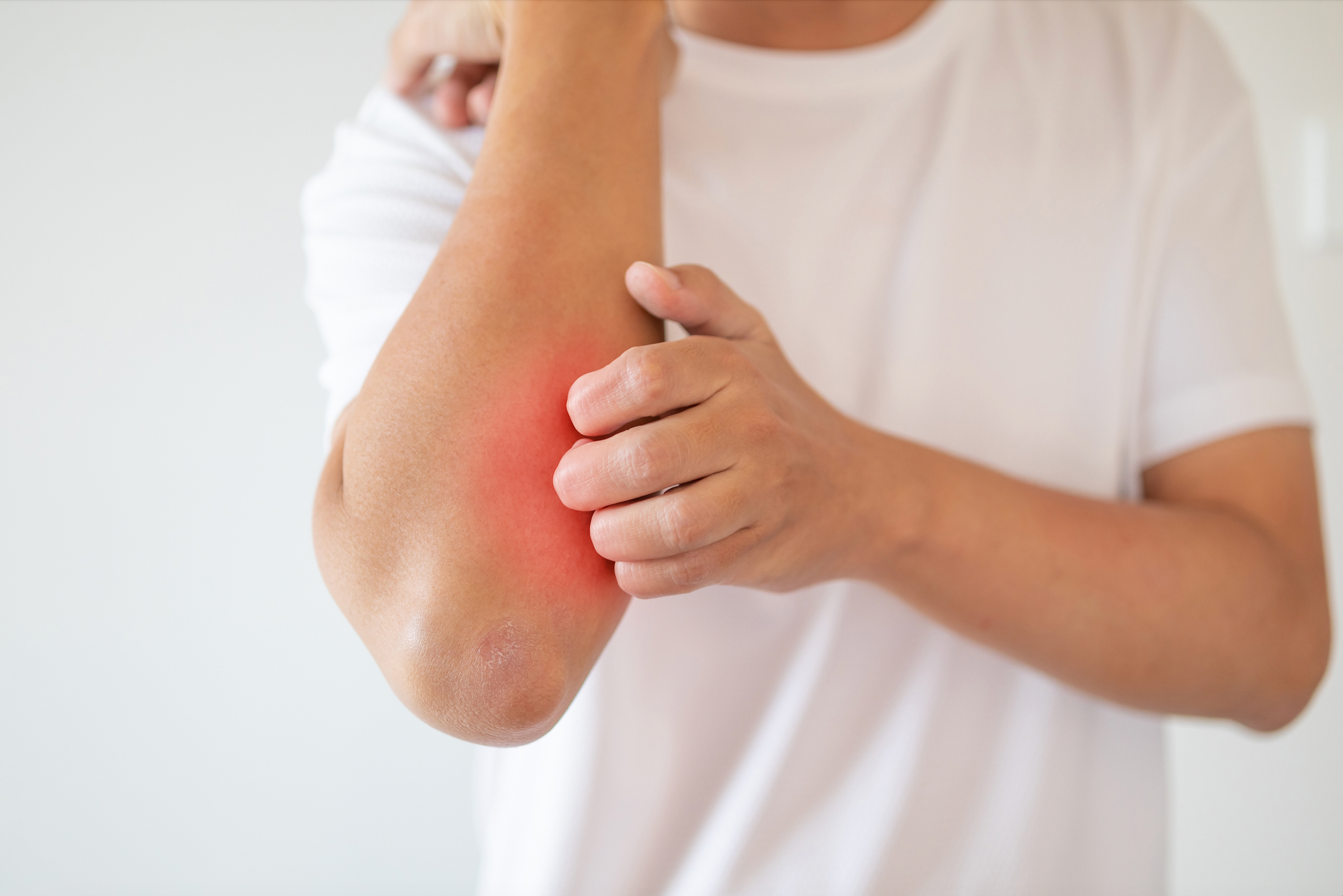 Psoriasis Improvement with Certolizumab Pegol Persisted a Year Later