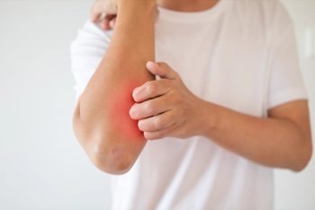 Psoriasis Improvement with Certolizumab Pegol Persisted a Year Later