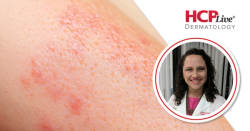 Guidelines on Genetic Disorders of the Skin and Pediatric Patients, With Yasmine Kirkorian, MD