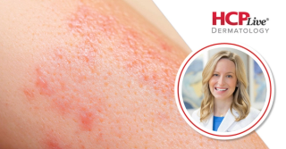 Emerging Therapeutic Options for Alopecia Areata in Adolescents, With Brittany Craiglow, MD