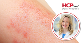 Emerging Therapeutic Options for Alopecia Areata in Adolescents, With Brittany Craiglow, MD