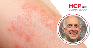 Discussing Zasocitinib and Other TYK2 Inhibitors for Psoriasis, With Ronald Vender, MD
