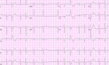 ECG computer print out of atrial fibrillation in an older women