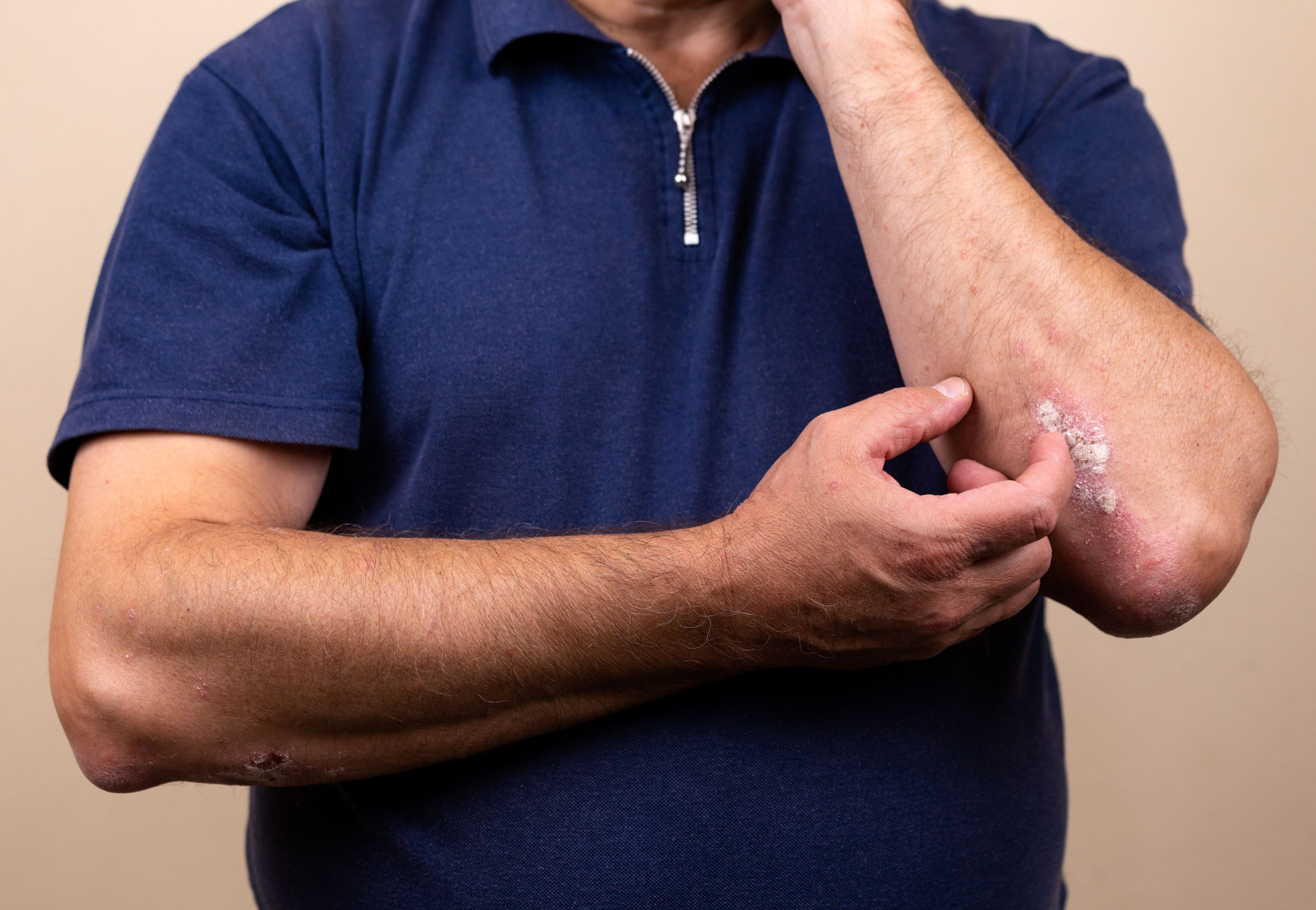 SYSA1902 Clinically Equivalent to Ustekinumab for Plaque Psoriasis | Image Credit: Adobe Stock