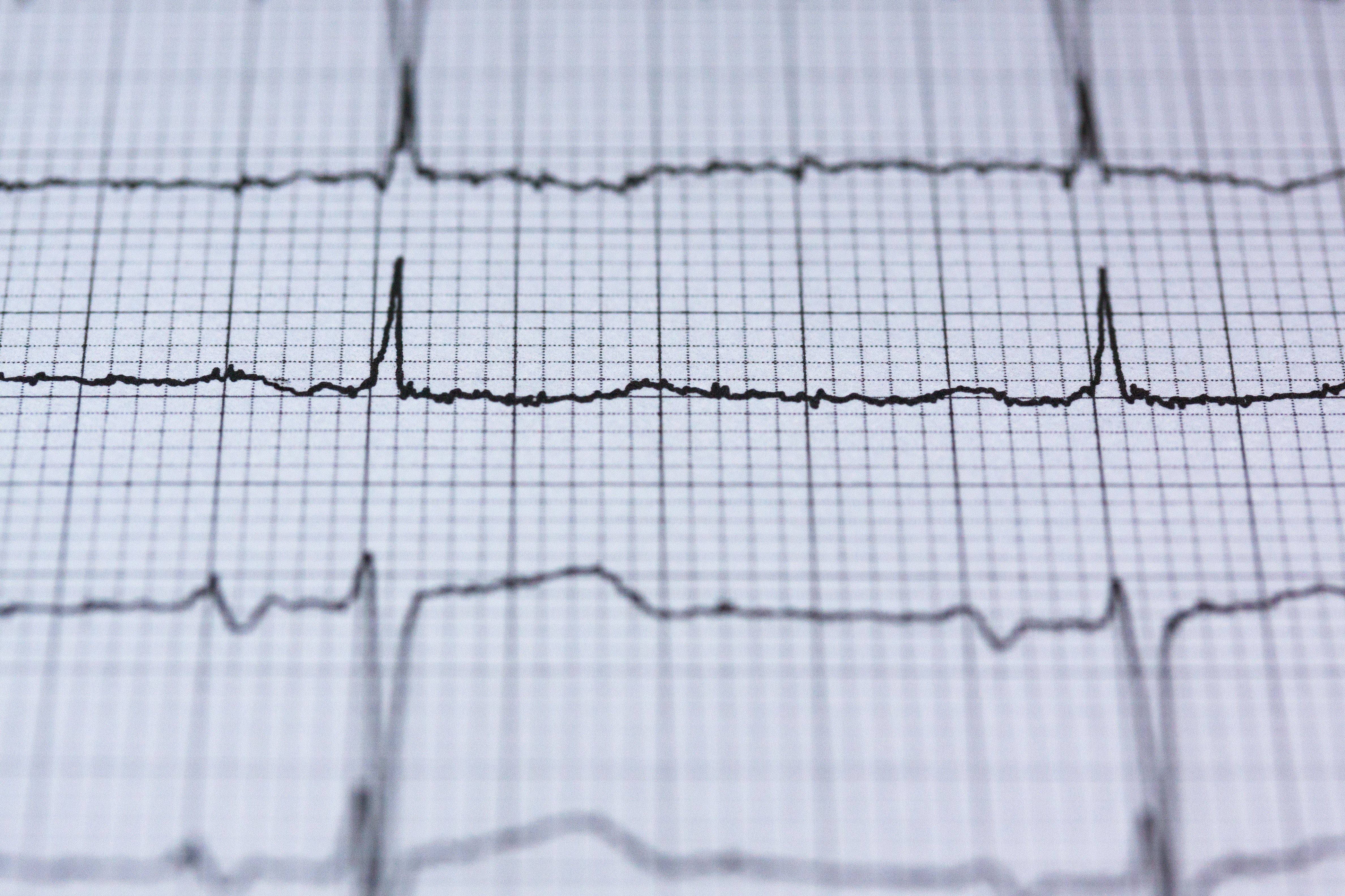 Atrial Fibrillation More Common in Adults with Sickle Cell Disease
