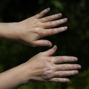 Case Study Points to Potential New Treatment for Patients with Vitiligo