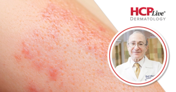 Highlighting Recent Findings on Icotrokinra, Other Psoriasis Developments, with Mark Lebwohl, MD