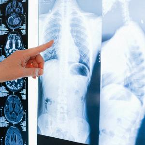Target BMI Among Patients with Cystic Fibrosis to be Reconsidered According to New Study