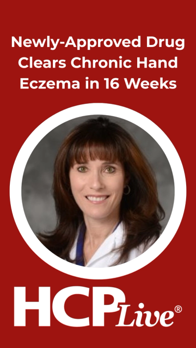Newly-Approved Drug Clears Chronic Hand Eczema in 16 Weeks