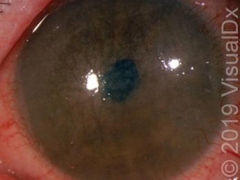 Image IQ: 7-year-old boy with photophobia