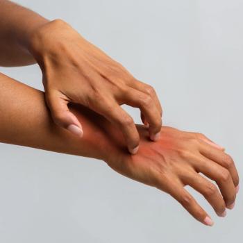 Menopause May Worsen Symptoms of Psoriasis, New Study Reveals | Image Credit: Adobe Stock