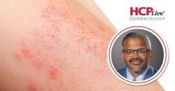 No New Safety Signals Over 3 Years in HS With Bimekizumab: Amit Garg, MD