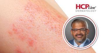 No New Safety Signals Over 3 Years in HS With Bimekizumab: Amit Garg, MD