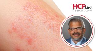 No New Safety Signals Over 3 Years in HS With Bimekizumab: Amit Garg, MD