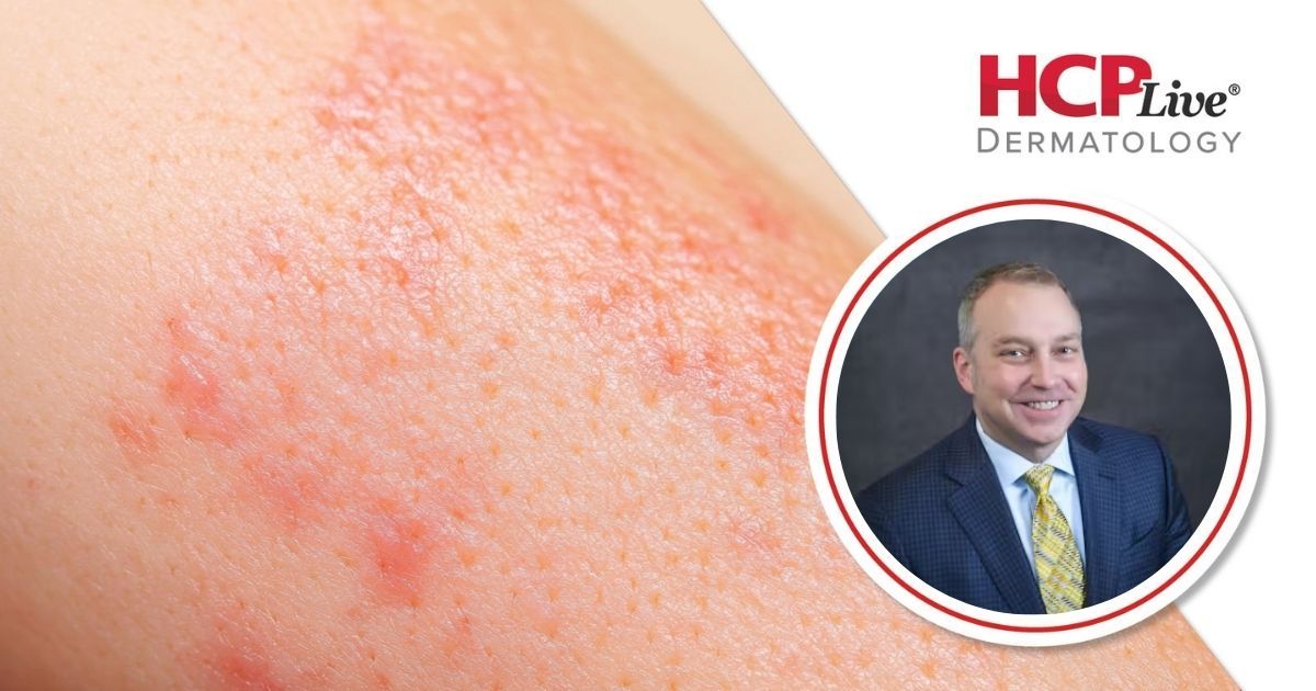 Understanding Patient Preferences in Psoriasis, With Andrew Blauvelt, MD, MBA