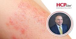 ONWARD: Oral Envudeucitinib Demonstrates High PASI Responses in Phase 3, With Andrew Blauvelt, MD