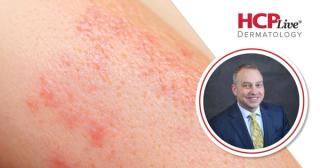 IL-23 or IL-17 for Preventing Psoriasis Progression into PsA, With Andrew Blauvelt, MD, MBA