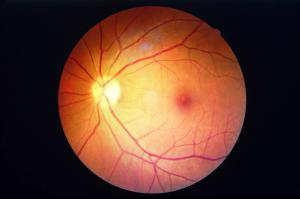 Diabetes Retinopathy, (©AdobeStock_Koolsabuy)