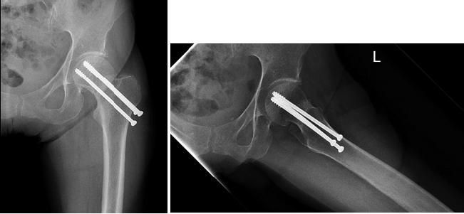 Managing Hip Fractures in Older Patients: Perioperative Decision Making Managing Hip Fractures in Older Patients: Perioperative Decision Making