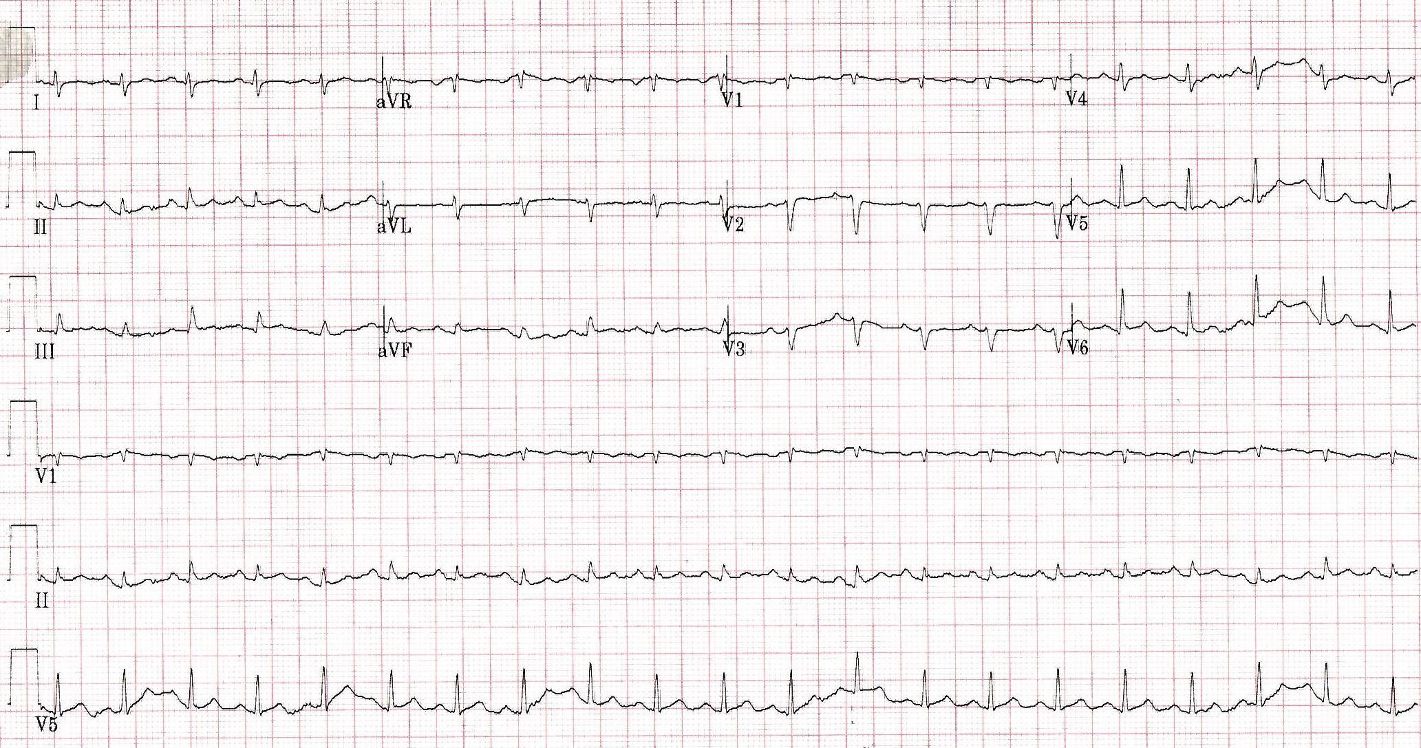 EKG of the case report's featured patient.
