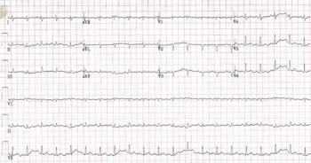 EKG of the case report's featured patient.