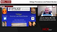 EP. 1 Vitiligo Prevalence and Patient Burden