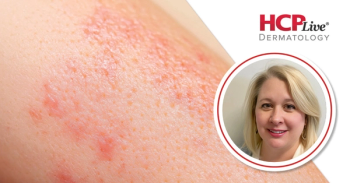 RLS-1496 Cream Reduces Actinic Keratosis Lesions
