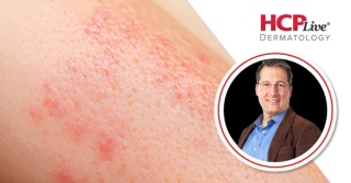 IL-13 Inhibitor Response Can Guide Patch Testing Decisions in Eczematous Dermatitis