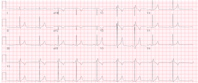 Right Bundle Branch Block And Presyncope In A 25 Year Old Man