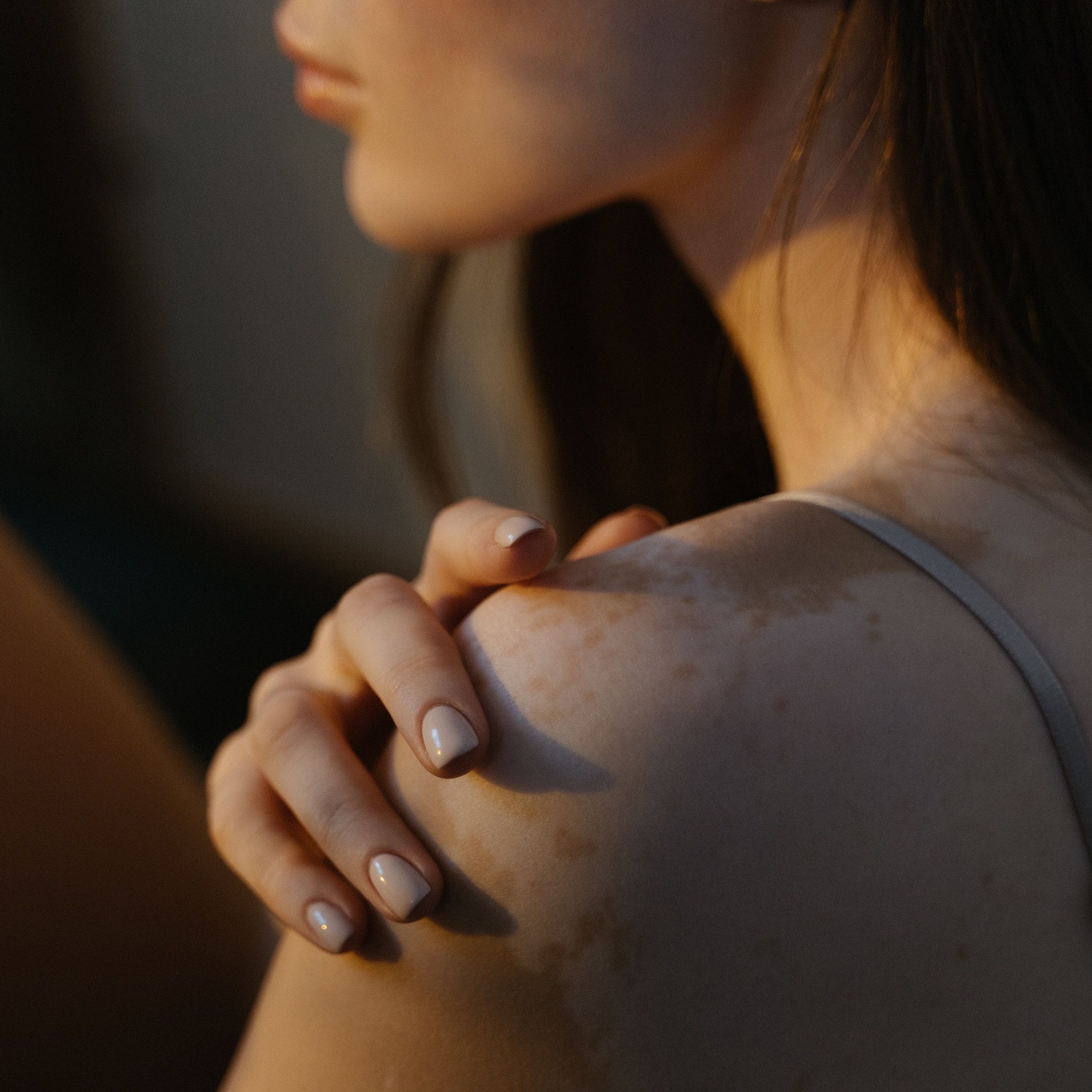 Camouflage, Psychotherapy with Vitiligo Management Improves Patient Care