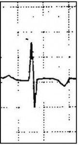 The Inverted T Wave Differential Diagnosis in the Adult Patient