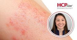 Povorcitinib Delivers Deepening Responses Through 54 Weeks in Moderate-to-Severe HS, With Martina Porter, MD