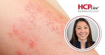 Povorcitinib Delivers Deepening Responses Through 54 Weeks in Moderate-to-Severe HS, With Martina Porter, MD
