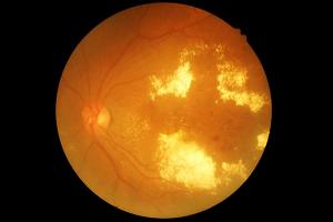 Considering Three Major Developments in the Diabetes Retinopathy Industry