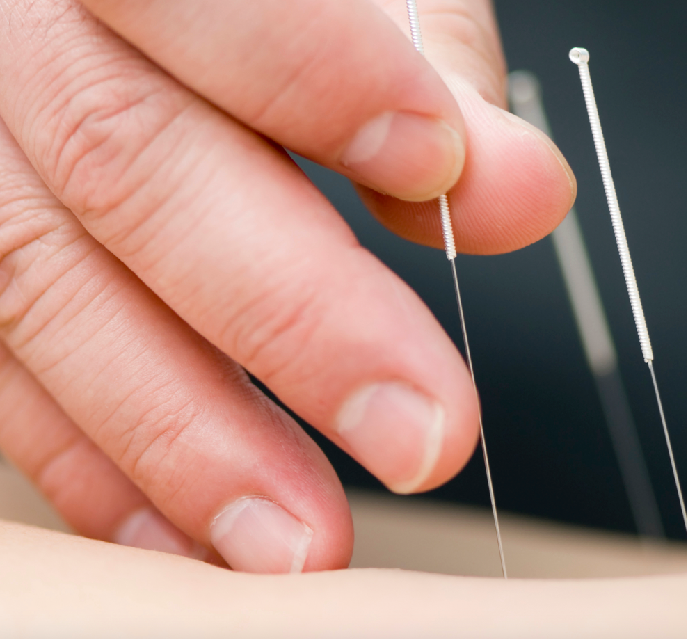 Studies Focused on Benefits of Acupuncture, Electroacupuncture Increasing in Number in Fibromyalgia