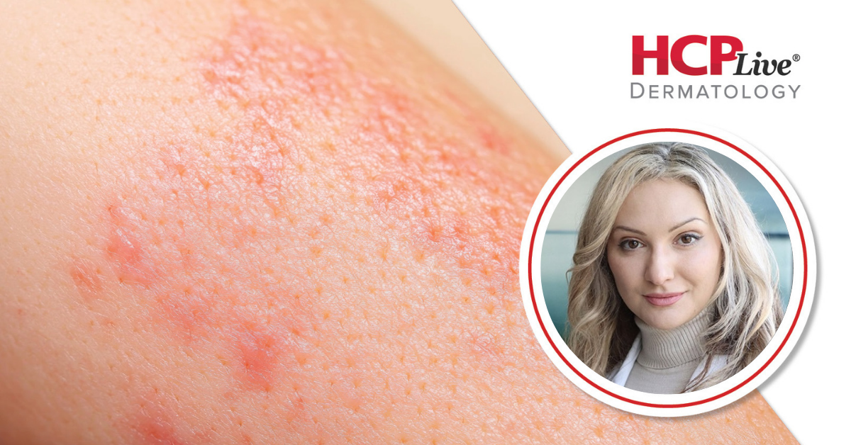 How Upadacitinib Could Expand Options for Severe Alopecia Areata, With Natasha Mesinkovska, MD, PhD