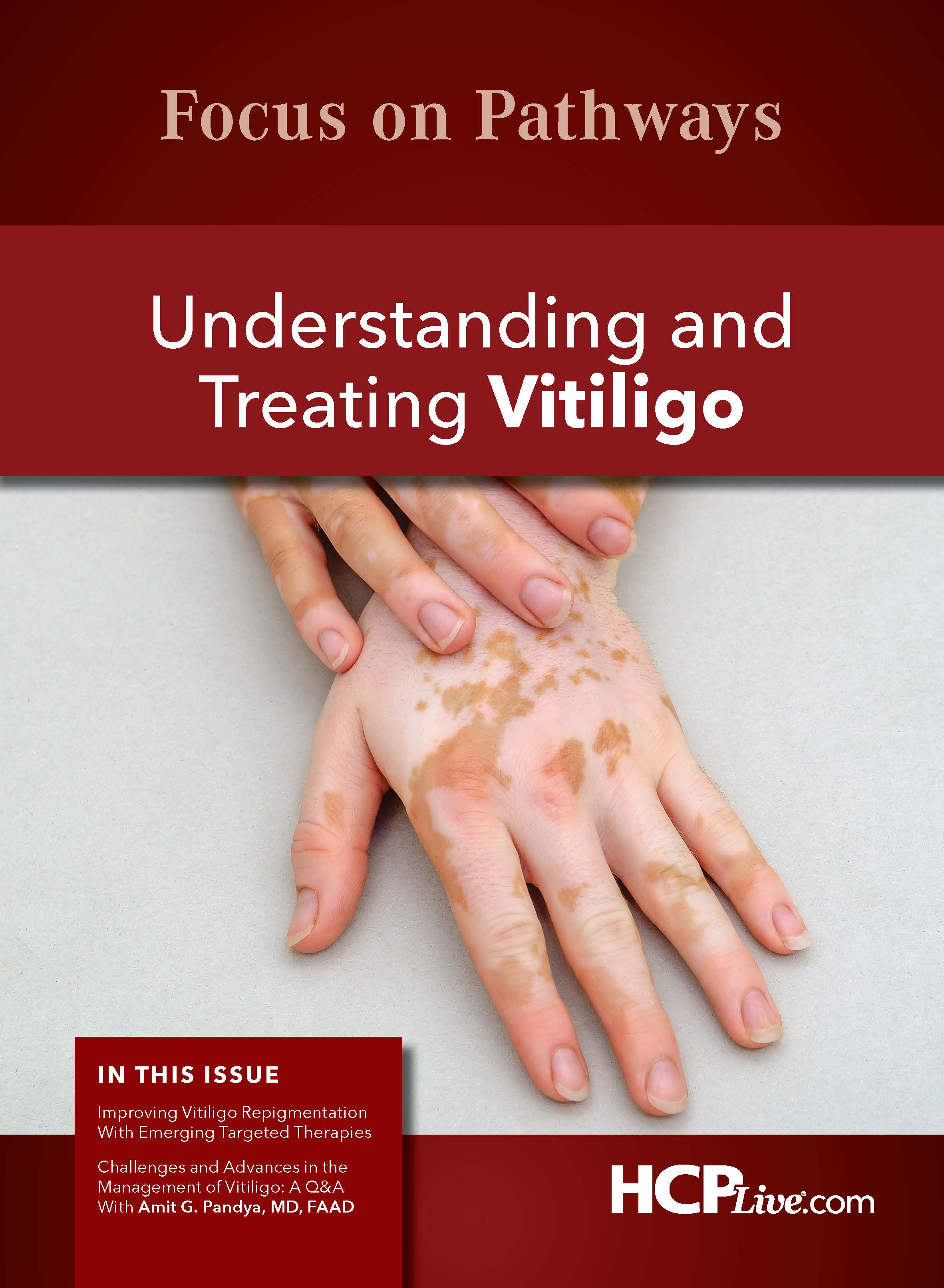 Improving Vitiligo Repigmentation With Emerging Targeted Therapies