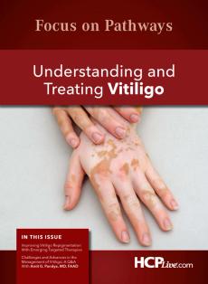 Understanding and Treating Vitiligo