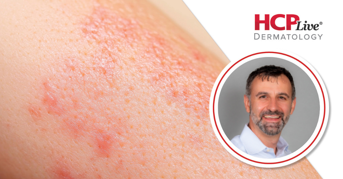 What is the Role of Immunology in Atopic Dermatitis Care? With Jay Lieberman, MD