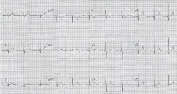 Pediatric ECG printout | Credit: Brady Pregerson, MD