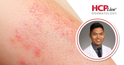 New Findings on Acne Incidence in Transgender Individuals, With Howa Yeung, MD, MSc