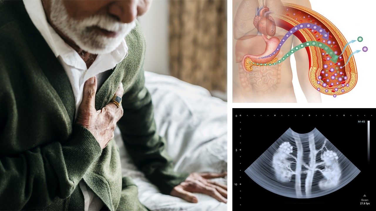 Renal Failure, Diabetes Linked to Increased Mortality in Post-Myocardial Infarct
