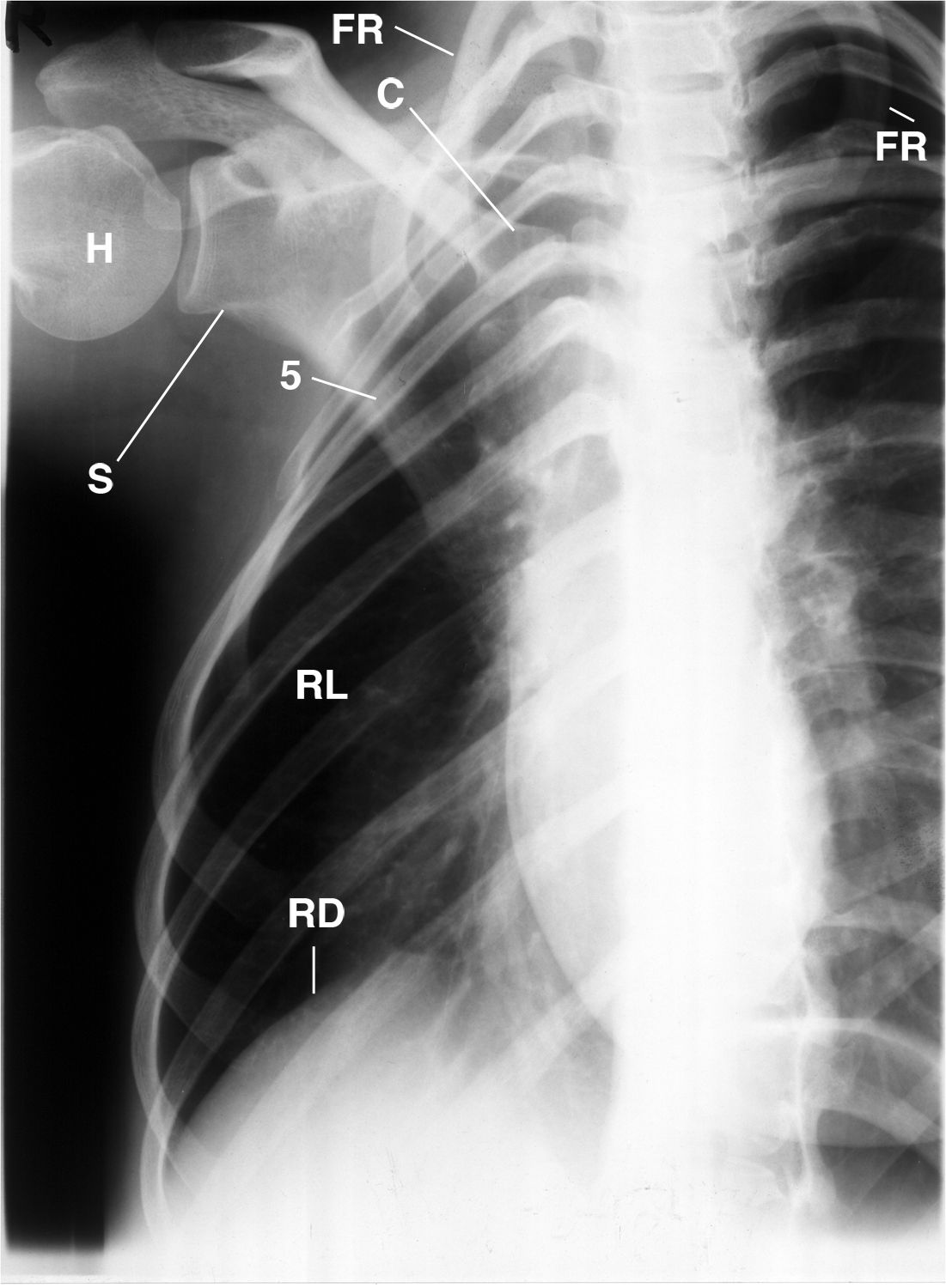 Why Does This Patient Have a Hyperlucent Right Lung and Rib Deformities?