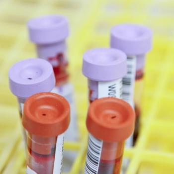 Trend Indicated Between Anemia and Childhood Inflammatory Bowel Disease | Image Credit: Unsplash