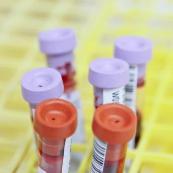 Serum Uric Acid Levels Linked to Risk of Dyslipidemia in Type 2 Diabetes | Image Credit: National Cancer Institute